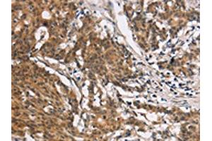 The image on the left is immunohistochemistry of paraffin-embedded Human gastic cancer tissue using ABIN7190329(COL7A1 Antibody) at dilution 1/25, on the right is treated with synthetic peptide. (COL7A1 antibody)