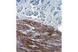 Paraformaldehyde-fixed, paraffin embedded human colon carcinoma tissue, Antigen retrieval by boiling in sodium citrate buffer (pH6. (Actin antibody)