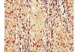 Immunohistochemistry of paraffin-embedded human liver cancer using ABIN7147989 at dilution of 1:100 (Coagulation Factor IX antibody  (AA 144-239))