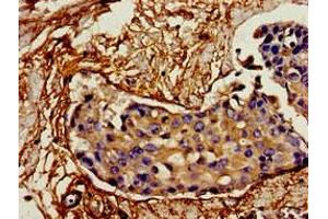 Immunohistochemistry of paraffin-embedded human breast cancer using ABIN7156781 at dilution of 1:100 (IL12A antibody  (AA 23-219))