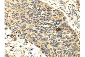 The image on the left is immunohistochemistry of paraffin-embedded Human esophagus cancer tissue using ABIN7131002(SEMA4F Antibody) at dilution 1/35, on the right is treated with fusion protein. (SEMA4F antibody)