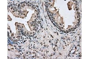 Immunohistochemical staining of paraffin-embedded Adenocarcinoma of colon tissue using anti-BSG mouse monoclonal antibody. (CD147 antibody)