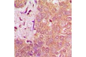 Immunohistochemical analysis of NAV1 staining in human breast cancer formalin fixed paraffin embedded tissue section. (NAV1 antibody)