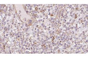 ABIN6273211 at 1/100 staining Human lymph cancer tissue by IHC-P. (CNPY2/MSAP antibody  (C-Term))