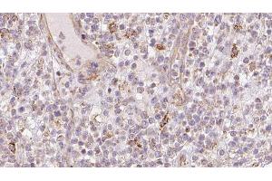 ABIN6273211 at 1/100 staining Human lymph cancer tissue by IHC-P. (CNPY2/MSAP antibody  (C-Term))