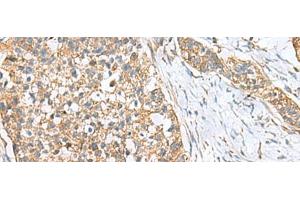 Immunohistochemistry of paraffin-embedded Human esophagus cancer tissue using CEMIP Polyclonal Antibody at dilution of 1:120(x200) (CEMIP antibody)