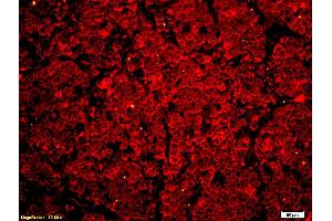 Formalin-fixed and paraffin embedded human lung carcinoma labeled with Anti Phospho-MLK3 (Thr277/Ser281) Polyclonal Antibody, Unconjugated at 1:200 followed by conjugation to the secondary antibody Goat Anti-Rabbit IgG, Cy3 conjugated used at 1:200 dilution for 40 minutes at 37°C. (MAP3K11 antibody  (pSer281, pThr277))