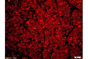 Formalin-fixed and paraffin embedded human lung carcinoma labeled with Anti Phospho-MLK3 (Thr277/Ser281) Polyclonal Antibody, Unconjugated at 1:200 followed by conjugation to the secondary antibody Goat Anti-Rabbit IgG, Cy3 conjugated used at 1:200 dilution for 40 minutes at 37°C. (MAP3K11 antibody  (pSer281, pThr277))