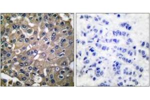 Immunohistochemistry analysis of paraffin-embedded human breast carcinoma tissue, using MMP-9 Antibody.