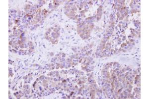 IHC-P Image SGTA antibody detects SGTA protein at cytosol on human lung adenocarcinoma by immunohistochemical analysis. (SGTA antibody  (Center))