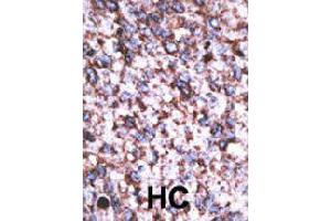 Formalin-fixed and paraffin-embedded human hepatocellular carcinoma tissue reacted with BACE2 polyclonal antibody  , which was peroxidase-conjugated to the secondary antibody, followed by AEC staining. (BACE2 antibody  (C-Term))