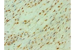 Immunohistochemistry of paraffin-embedded human breast cancer using ABIN7147792 at dilution of 1:100 (CLOCK antibody  (AA 577-846))