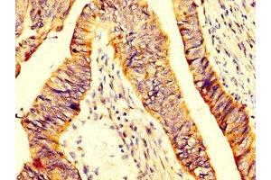 IHC image of ABIN7160496 diluted at 1:200 and staining in paraffin-embedded human colon cancer performed on a Leica BondTM system. (MYOC antibody  (AA 183-294))