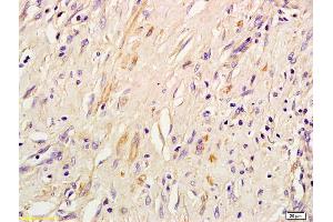 Formalin-fixed and paraffin embedded human lung inflammation labeled with Rabbit Anti IRS-3 Polyclonal Antibody, Unconjugated (ABIN726005) at 1:200 followed by conjugation to the secondary antibody and DAB staining