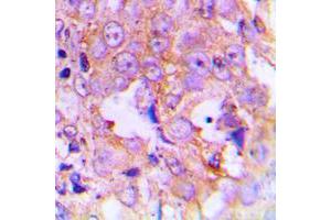 Immunohistochemical analysis of EEF2 (pT56) staining in human lung cancer formalin fixed paraffin embedded tissue section. (EEF2 antibody  (N-Term, pSer56))