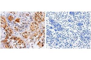 The image on the left is immunohistochemistry of paraffin-embedded Human lung cancer tissue using 31024 (AAK1 Antibody) at dilution 1/30, on the right is treated with the fusion protein. (AAK1 antibody  (N-Term))