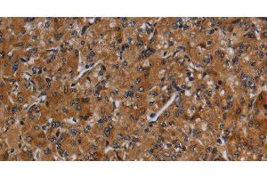 Immunohistochemistry of paraffin-embedded Human prostate cancer using CYP1A2 Polyclonal Antibody at dilution of 1:40 (CYP1A2 antibody)