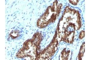 IHC testing of FFPE human prostate carcinoma with TDP2 antibody (clone TDP2/1258).