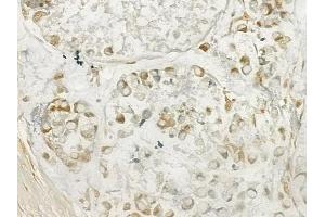 ABIN6262558 and ABIN6277619 at 1/100 staining human gastric carcinoma by IHC-P. (IL27 antibody  (Internal Region))