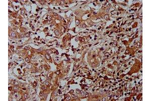 IHC image of ABIN7165027 diluted at 1:400 and staining in paraffin-embedded human liver cancer performed on a Leica BondTM system.
