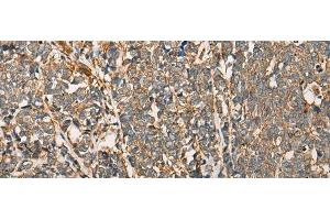Immunohistochemistry of paraffin-embedded Human lung cancer tissue using MYL12B Polyclonal Antibody at dilution of 1:25(x200) (MYL12B antibody)