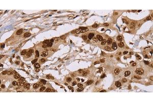 Immunohistochemistry of paraffin-embedded Human colon cancer using NUP50 Polyclonal Antibody at dilution of 1:30 (NUP50 antibody)