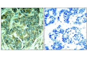 Immunohistochemical analysis of paraffin-embedded human breast carcinoma tissue, using p62Dok (phospho- Tyr398) antibody (E011277). (DOK1 antibody  (pTyr398))