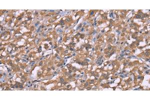 Immunohistochemistry of paraffin-embedded Human thyroid cancer using Histamine H3 Receptor Polyclonal Antibody at dilution of 1:50 (HRH3 antibody)