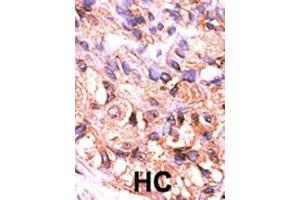 Formalin-fixed and paraffin-embedded human cancer tissue reacted with the primary antibody, which was peroxidase-conjugated to the secondary antibody, followed by AEC staining. (PPM1F antibody  (C-Term))