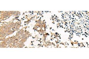 Immunohistochemistry of paraffin-embedded Human lung cancer tissue using GPR22 Polyclonal Antibody at dilution of 1:50(x200) (GPR22 antibody)