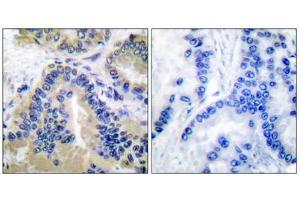 Immunohistochemical analysis of paraffin-embedded human lung carcinoma tissue, using Caspase 10 antibody.