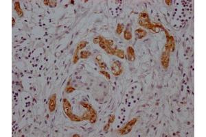 IHC image of ABIN7127620 diluted at 1:100 and staining in paraffin-embedded human pancreatic cancer performed on a Leica BondTM system. (Recombinant Midkine antibody)