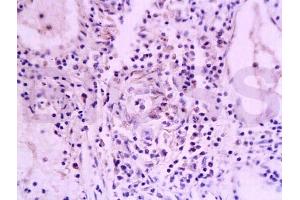 Formalin-fixed and paraffin embedded human oral squamous cell carcinoma labeled with Anti-TNFRSF18 Polyclonal Antibody (ABIN738741), Unconjugated at 1:200, followed by conjugation to the secondary antibody and DAB staining (TNFRSF18 antibody  (AA 201-274))