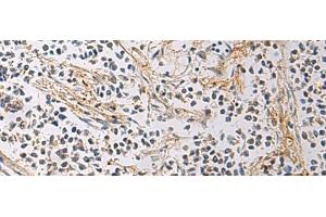Immunohistochemistry of paraffin-embedded Human breast cancer tissue using GMPR Polyclonal Antibody at dilution of 1:60(x200) (GMPR antibody)
