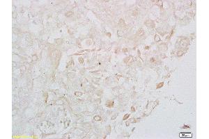 Formalin-fixed and paraffin embedded human cervical carcinoma labeled with Anti- LONP1 Polyclonal Antibody, Unconjugated  at 1:200 followed by conjugation to the secondary antibody (LONP1 antibody  (AA 361-460))