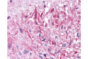Anti-GIPR / GIP Receptor antibody IHC of human Brain, Glioblastoma. (GIPR antibody  (Cytoplasmic Domain))