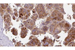 ABIN6277475 at 1/100 staining Human liver cancer tissue by IHC-P. (FSHR antibody  (Internal Region))
