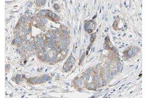 ABIN6267681 at 1/100 staining human Breast carcinoma tissue sections by IHC-P. (BAD antibody  (pSer136))