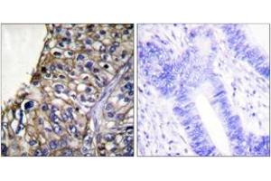 Immunohistochemistry analysis of paraffin-embedded human lung carcinoma tissue, using Claudin 7 Antibody. (Claudin 7 antibody  (AA 162-211))