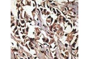 IHC analysis of FFPE human breast carcinoma tissue stained with the PRMT7 antibody (PRMT7 antibody  (AA 660-692))