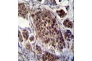 Immunohistochemistry analysis in formalin fixed and paraffin embedded human bladder carcinoma reacted with FRAT2 Antibody (C-term) followed by peroxidase conjugation of the secondary antibody and DAB staining. (FRAT2 antibody  (C-Term))