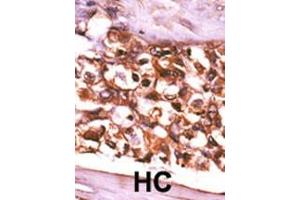 Formalin-fixed and paraffin-embedded human cancer tissue reacted with the primary antibody, which was peroxidase-conjugated to the secondary antibody, followed by AEC staining. (Ribokinase antibody  (N-Term))