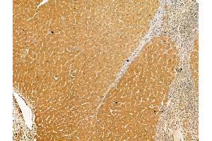 ABIN7094530 and ABIN7098579 at 1/100 staining Human liver cancer and adjacent normal tissues by IHC-P. (Glutaminase antibody  (C-Term))