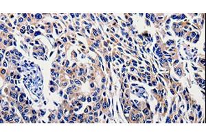 Immunohistochemistry of paraffin-embedded Human lung cancer tissue using IL10RB Polyclonal Antibody at dilution 1:60 (IL10RB antibody)