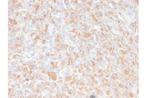 Formalin-fixed, paraffin-embedded human Histiocytoma stained with TNF alpha Mouse Monoclonal Antibody (4C6-H8). (TNF alpha antibody  (AA 115-130))