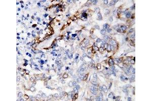 IHC-P: LAMC2 antibody testing of human lung cancer tissue (LAMC2 antibody  (C-Term))