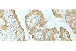 Immunohistochemistry of paraffin-embedded Human thyroid cancer tissue using ETAA1 Polyclonal Antibody at dilution of 1:25(x200)
