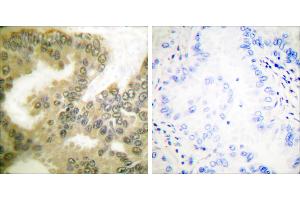 P-peptide - +Immunohistochemical analysis of paraffin-embedded human lung carcinoma tissue using Cyclin D3 (Phospho-Thr283) Antibody (#A0418). (Cyclin D3 antibody  (pThr283))