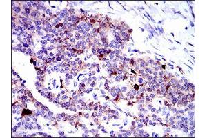 Immunohistochemical analysis of paraffin-embedded ovarian cancer tissues using ANXA1 mouse mAb with DAB staining. (Annexin a1 antibody  (AA 144-248))