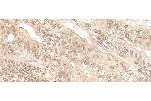 Immunohistochemistry of paraffin-embedded Human gastric cancer tissue using EXOSC9 Polyclonal Antibody at dilution of 1:35(x200) (EXOSC9 antibody)